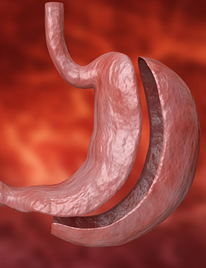 Cirurgia Bariátrica para obesidade