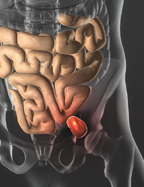 Cirurgia de hérnia inguinal, umbilical e incisional