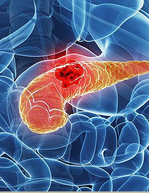 Cirurgia de doenças do pâncreas