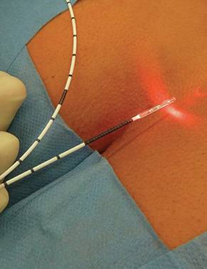 Cirurgia com Auxílio de Laser